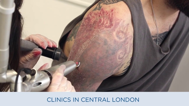 Considerations For Tattoo Removal