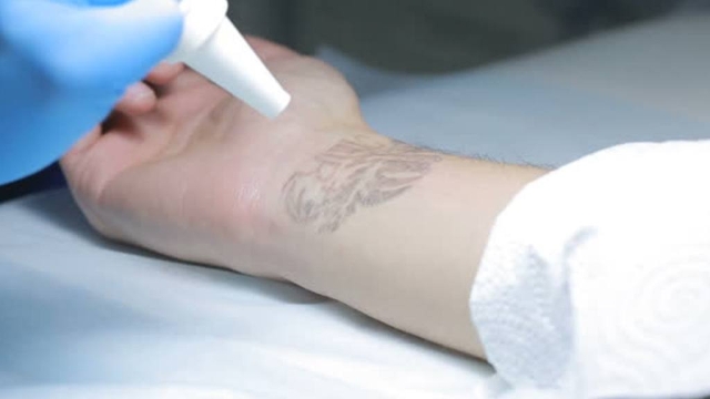 Is Ipl Tattoo Removal Right That You?
