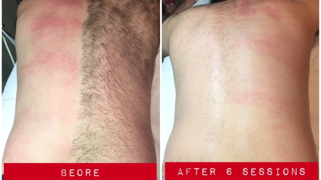 Laser Hair Removal: Unveiling the Smooth Secrets