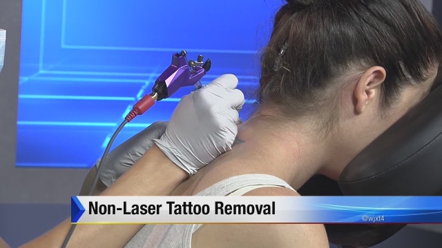 Tattoo Removal – Rid Yourself From That Tat