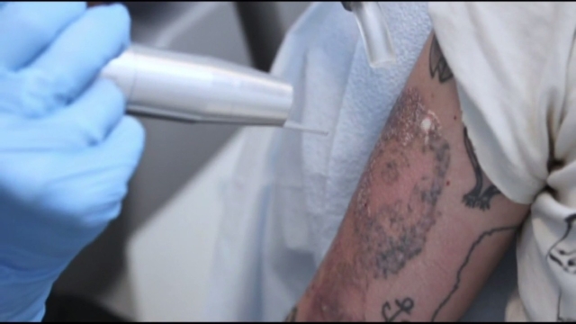 Tattoo Removers – What May Be The Safest Tattoo Removal Option?